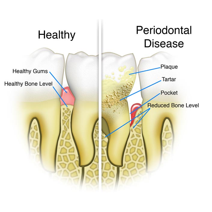 Gum (Periodontal) Treatments